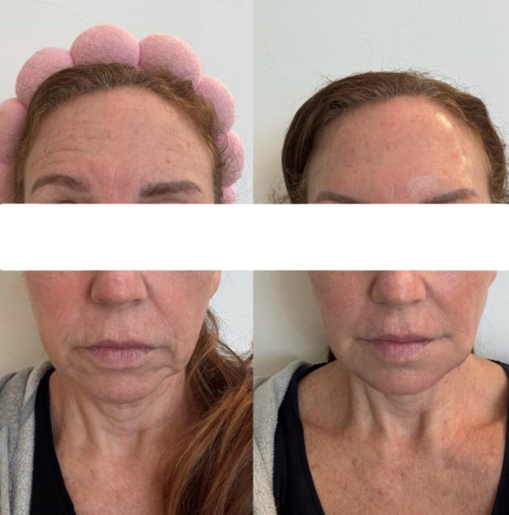 Corrección facial completa. En este caso, realizamos una corrección de la asimetría de la parte superior del rostro, un equilibrio de las cejas y un lifting general.
