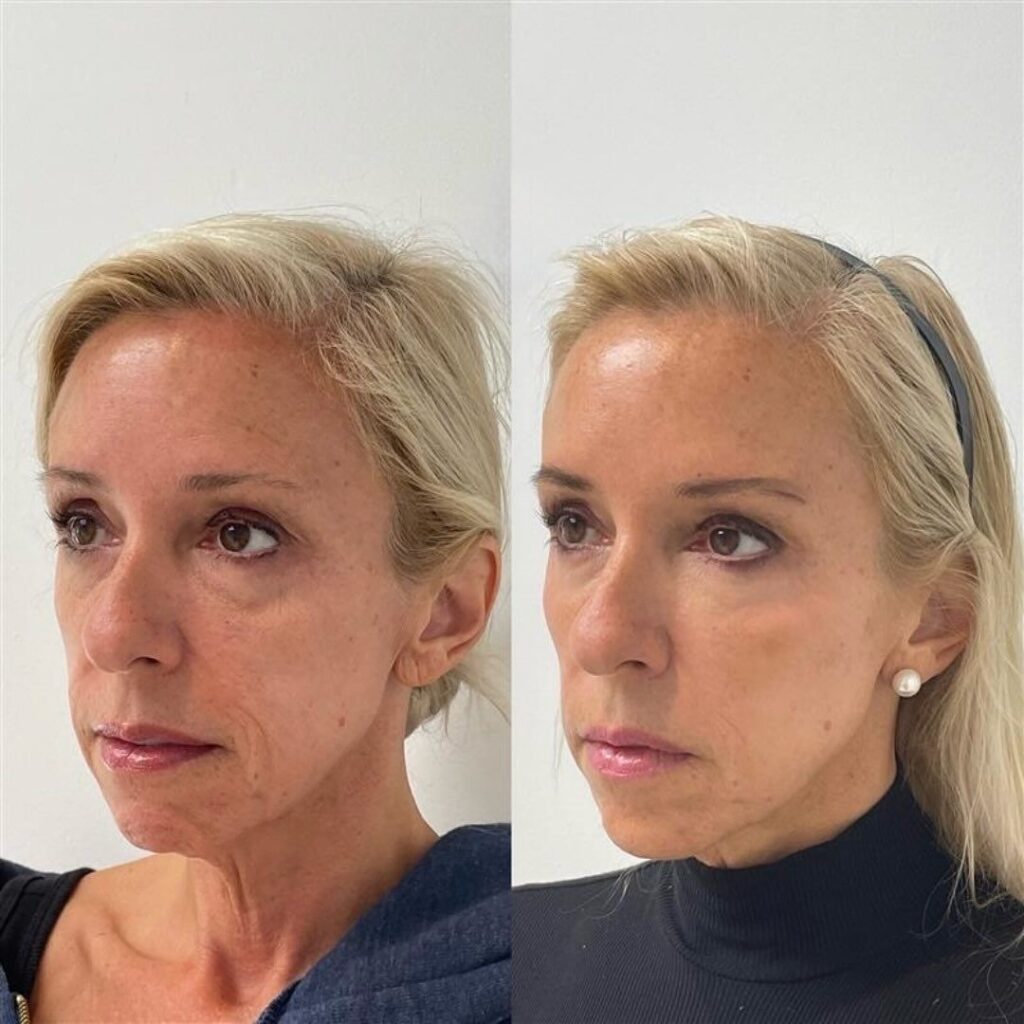 Botox + rellenos