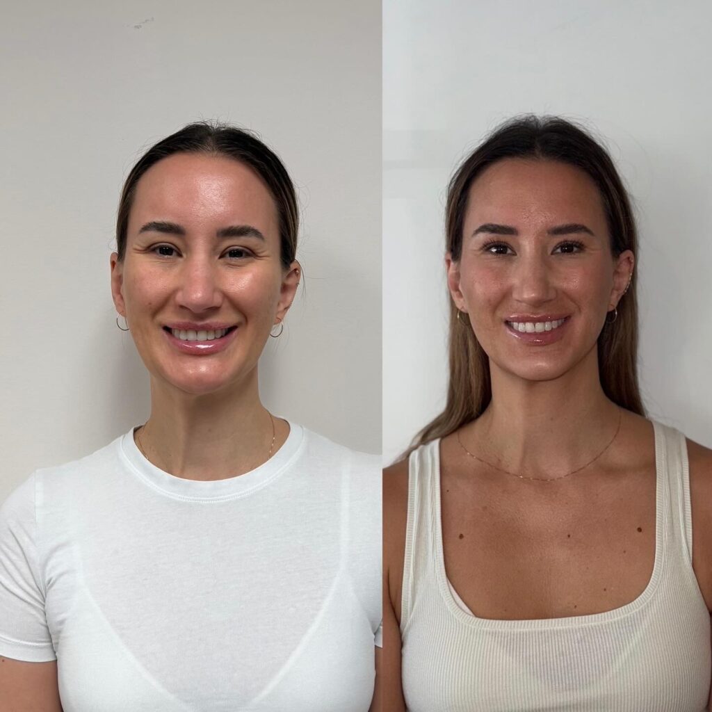 Botox para todo el rostro