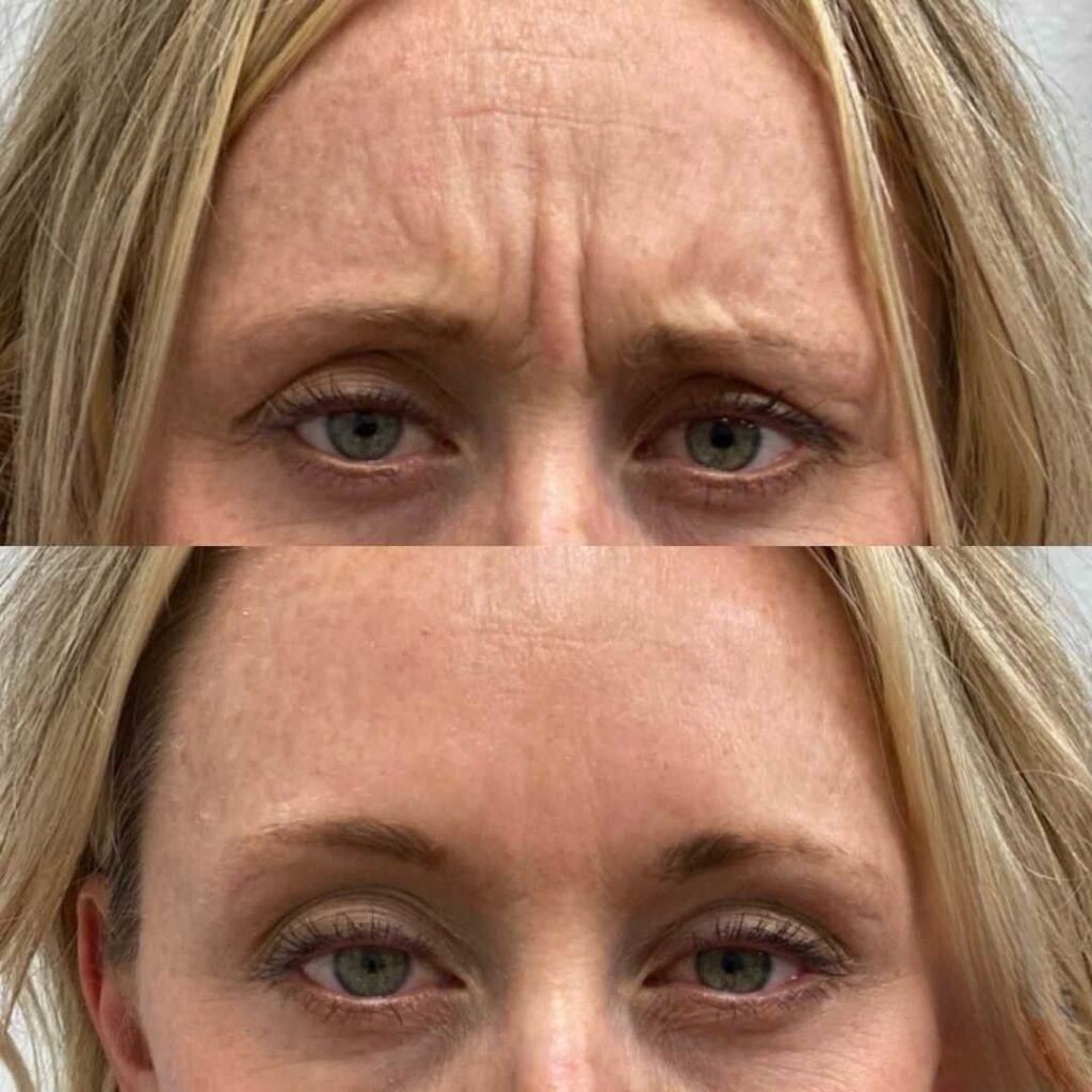 Botox forehead
