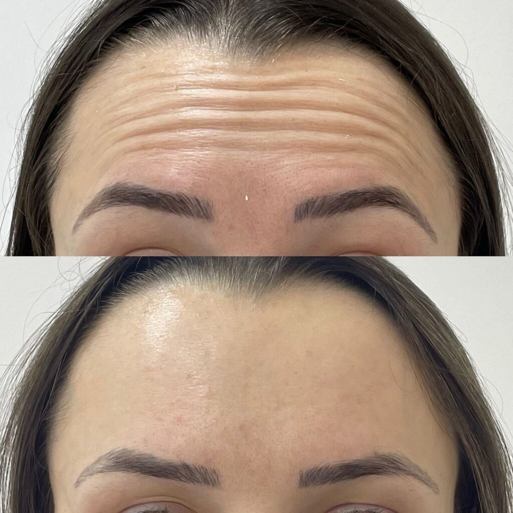 Botox en la frente