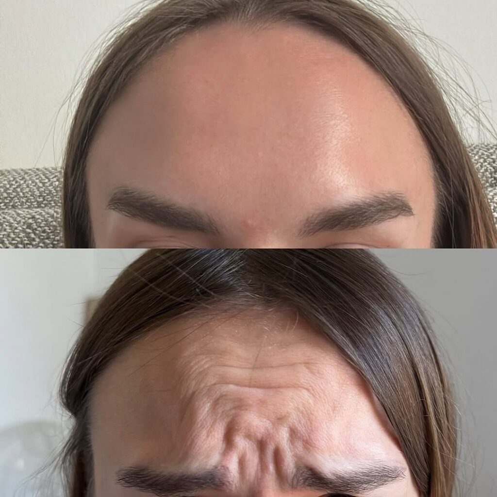 Resultados de la inyección de Botox