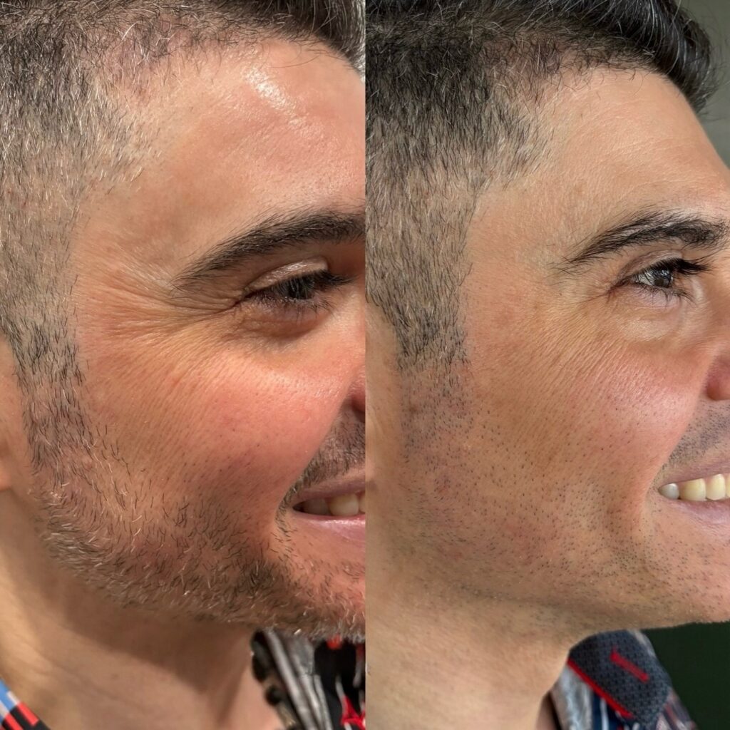 Botox para las arrugas alrededor de los ojos