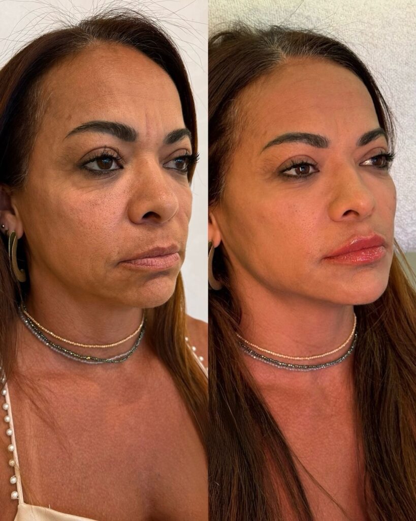 Rejuvenecimiento facial completo