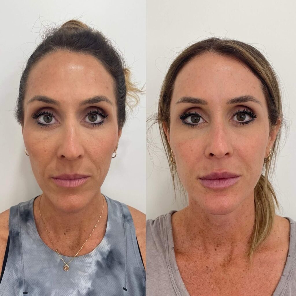Full face treatment