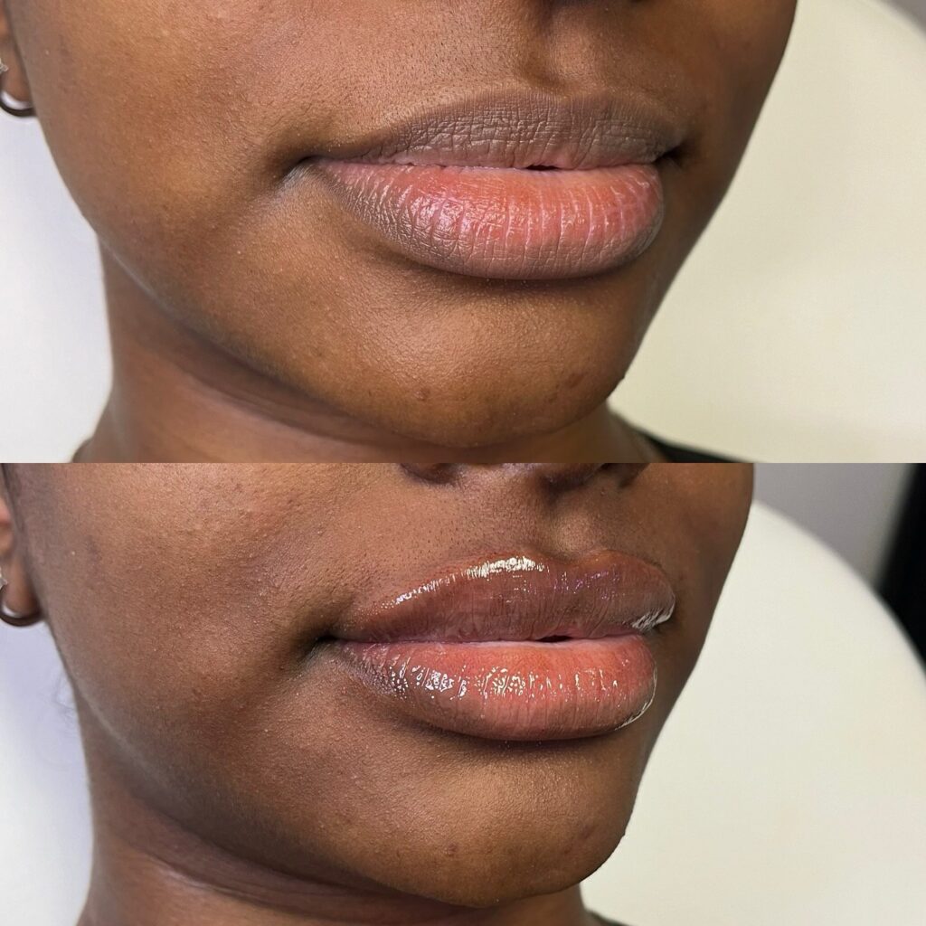 relleno de labios
