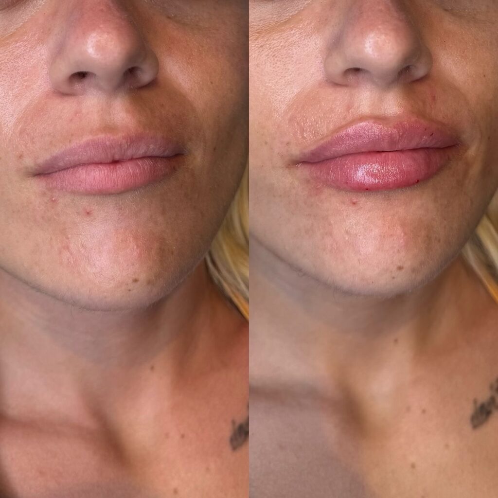 Lip filler