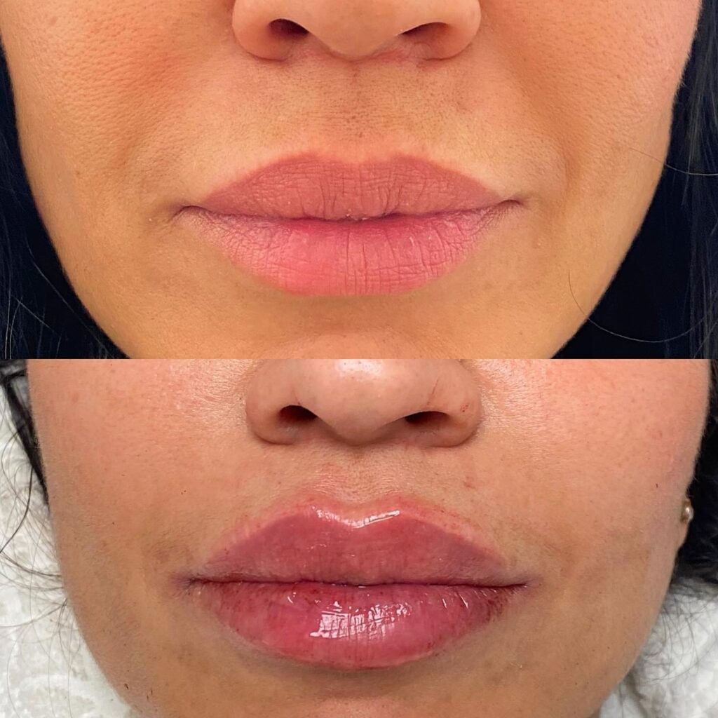 relleno de labios