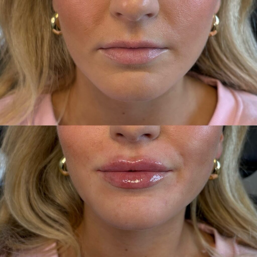 relleno de labios