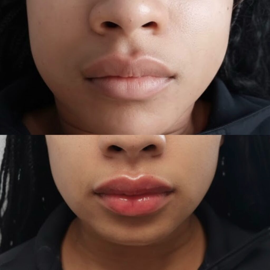 relleno de labios