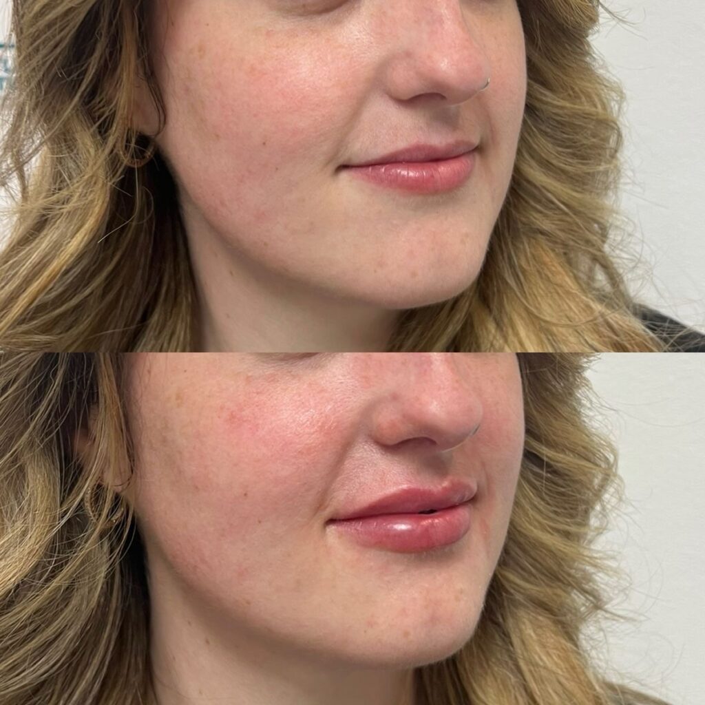 Lip filler