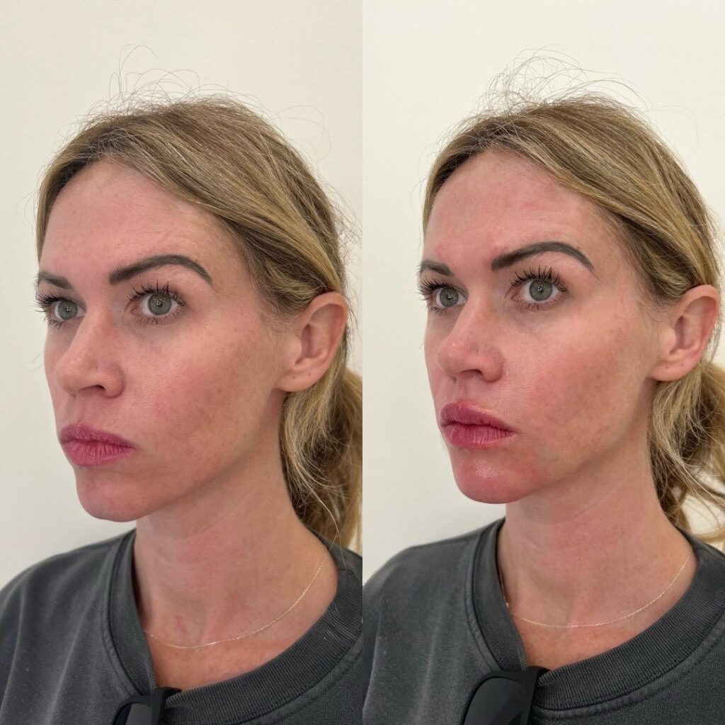 Lips + Chin filler