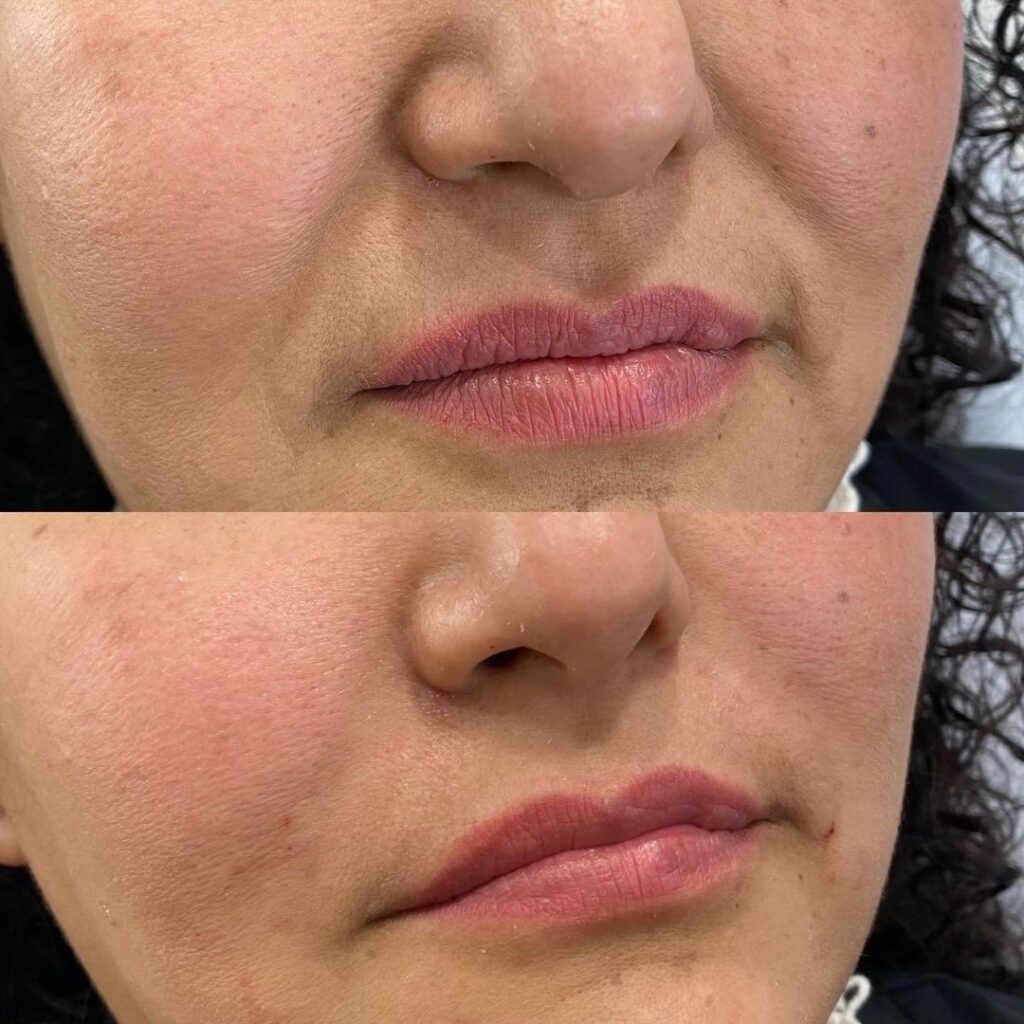 Nasolabial folds