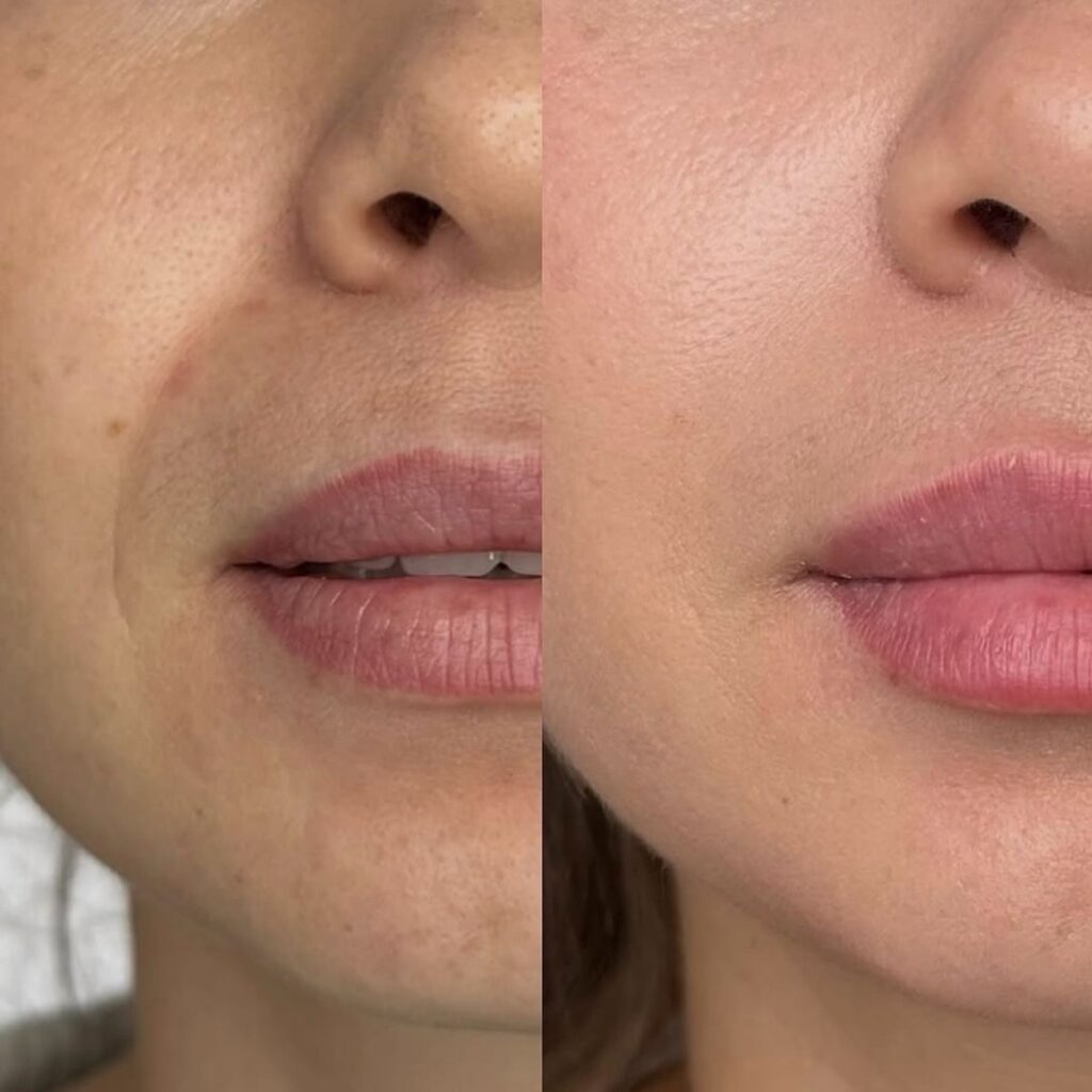 pliegues nasolabiales