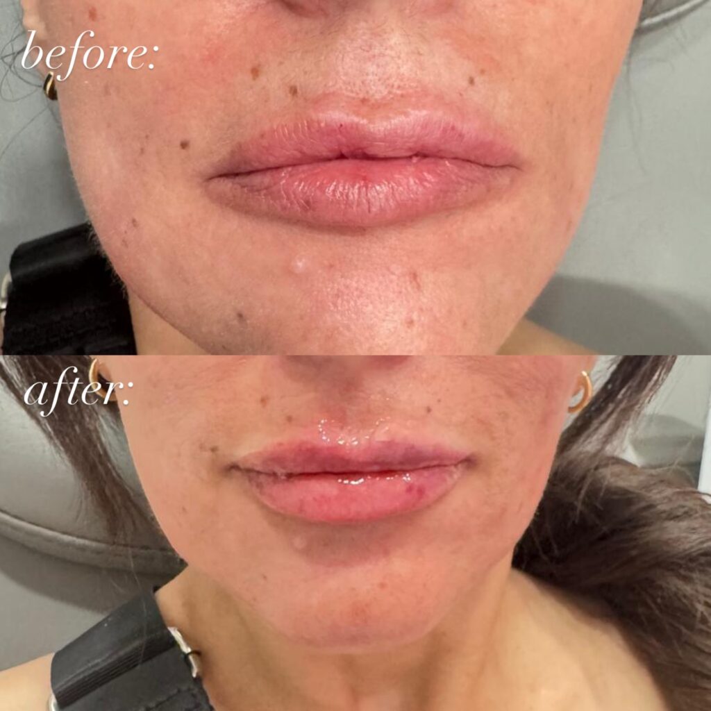 Textura de labios natural. La cantidad de relleno ajustada con precisión proporciona una textura suave, natural y aterciopelada.