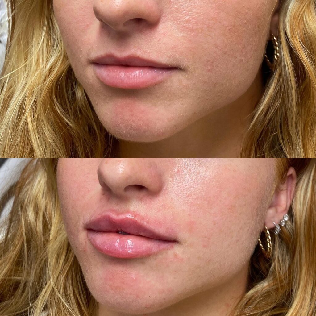 Relleno de labios natural