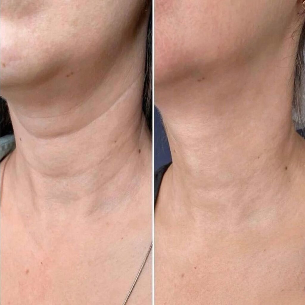 Lifting de cuello al estilo Nefertiti