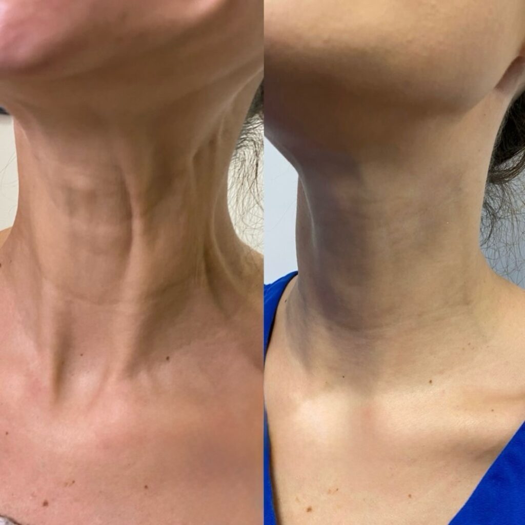 Nefertiti Neck lift