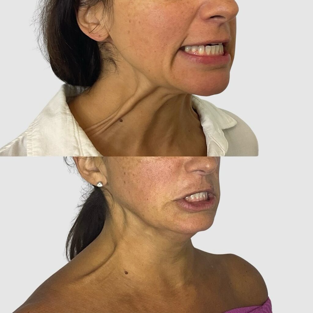 Lifting de cuello al estilo Nefertiti
