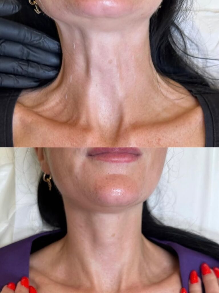 Lifting de cuello al estilo Nefertiti