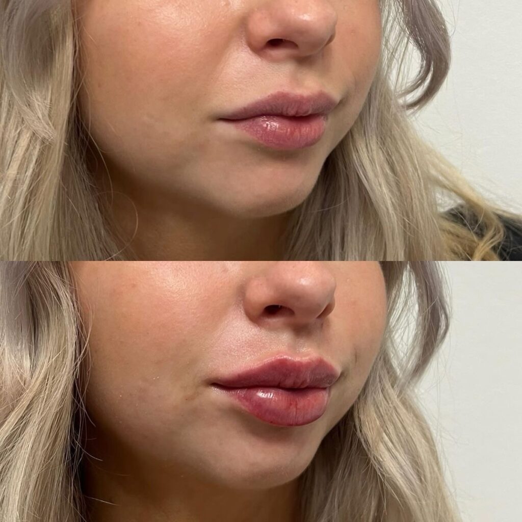 relleno de labios