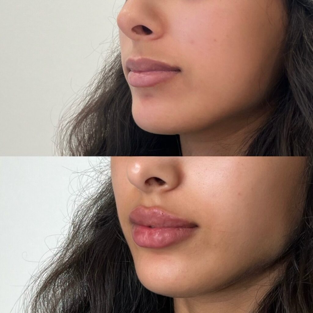 El relleno de labios perfecto