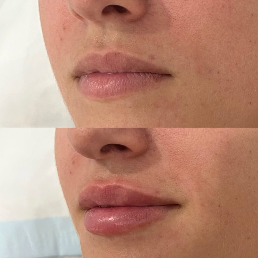 Perfect lip filler