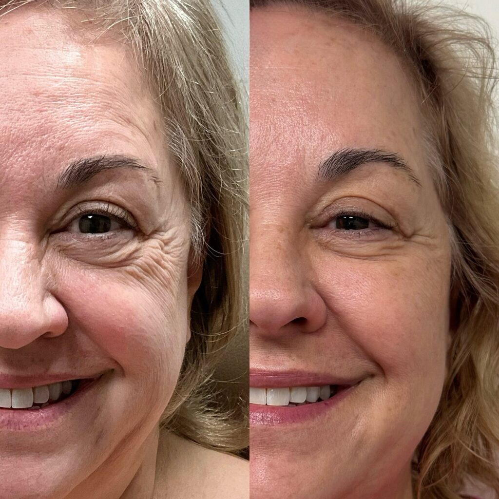 Resultados del uso de Sculptra