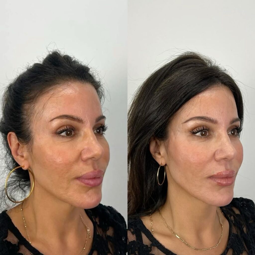 Temple filler and chin filler