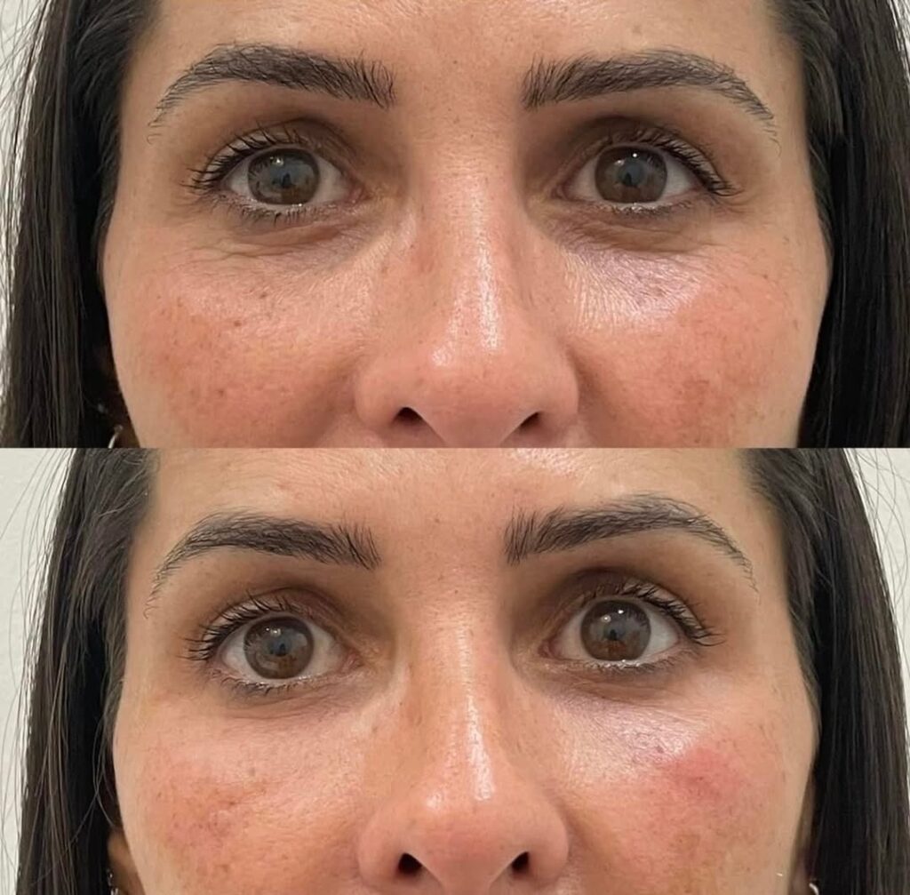 Under eye filler