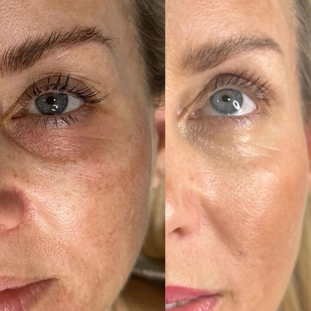 Under eye filler