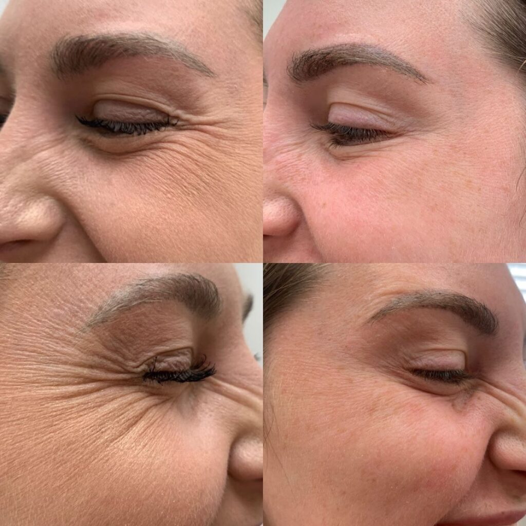 Botox