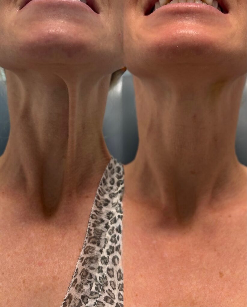 Lifting de cuello al estilo Nefertiti