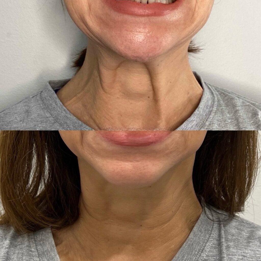 Lifting de cuello al estilo Nefertiti